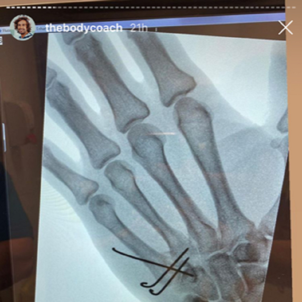 Joe Wicks in hospital on a drip fighting infection after hand injury