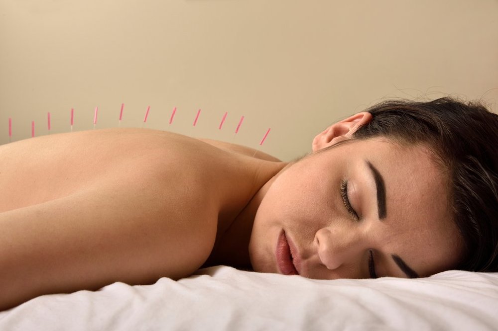 Acupuncture can help people to dream better