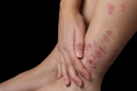 Psoriasis is an incurable condition