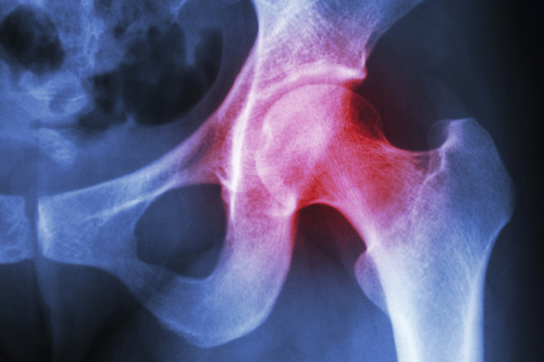 7 ways to treat hip arthritis