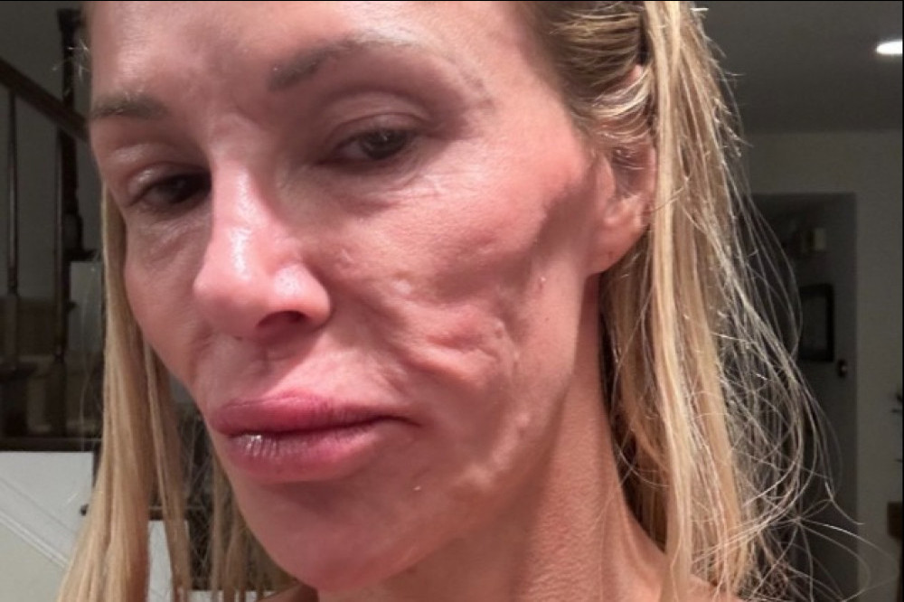 Brandi Glanville's facial disfigurement is impacting her love life