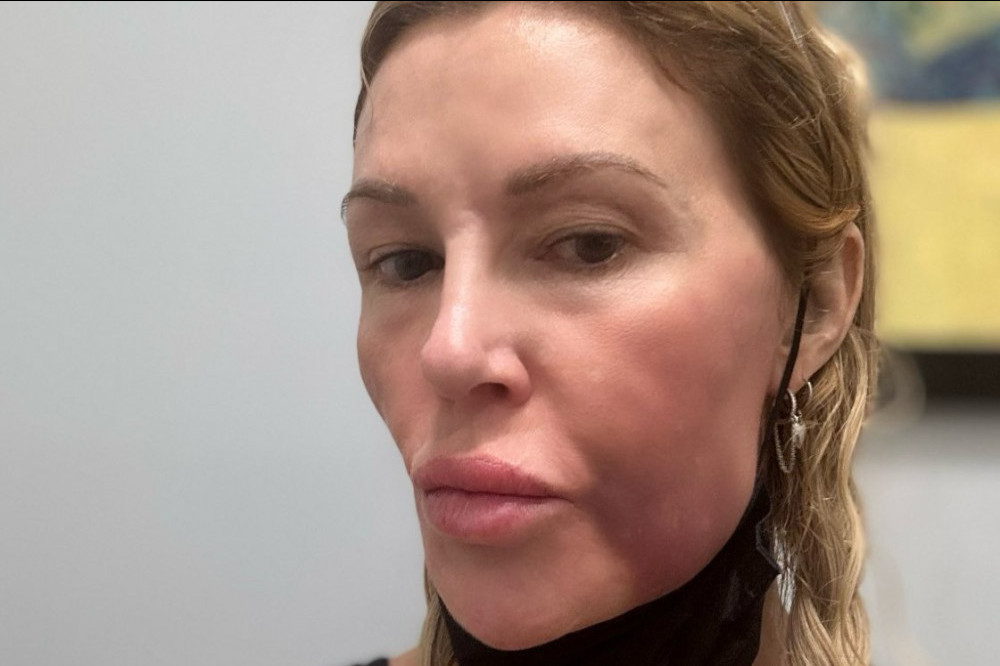 Brandi Glanville 'wishes she knew' what was wrong with her face as she shares medical theories