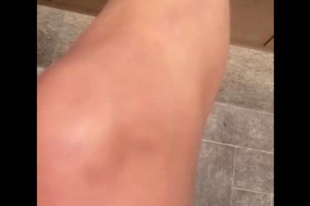 Chrissy Teigen's bruised knee (c) Instagram