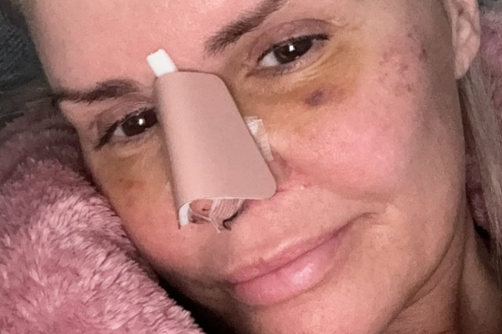 Kerry Katona is healing after nose surgery