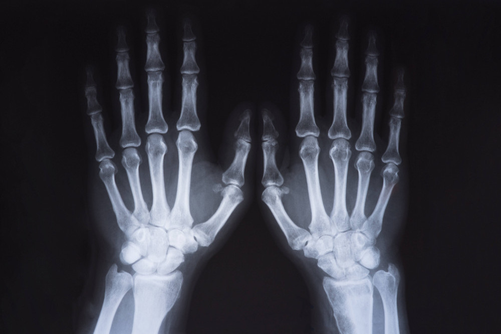 X-rays could be made more accurate by artificial intelligence