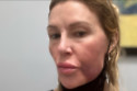 Brandi Glanville's swollen face (c) X