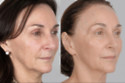 Shirley Ballas says her NeoGen treatments have rejuvenated her face (c) NeoGenPlasma.co.uk