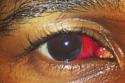 Usher's eye injury