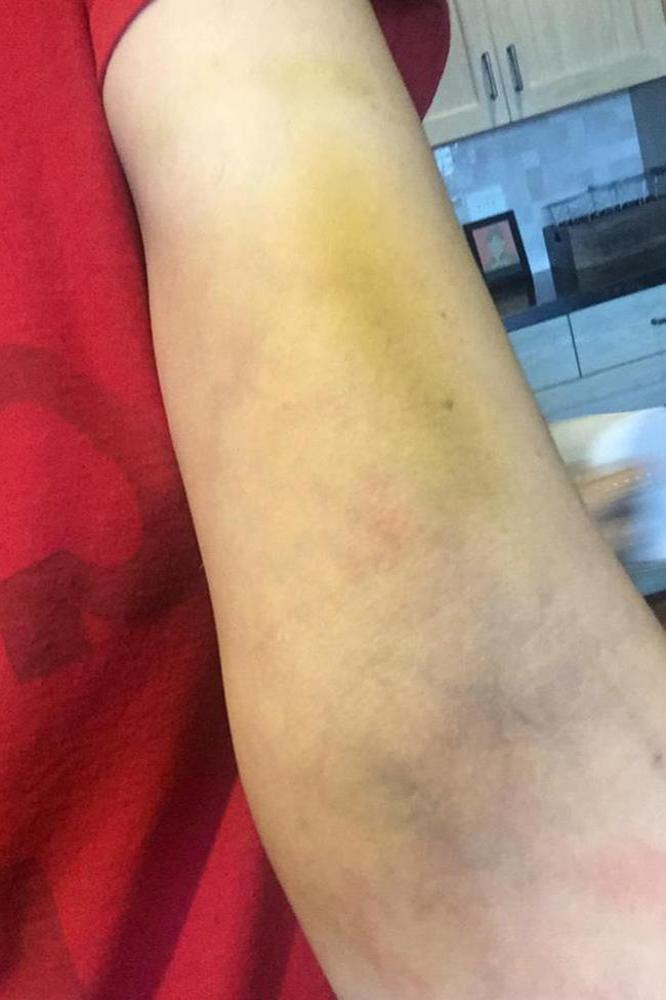 Sarah Silverman's bruised arm (c) Facebook