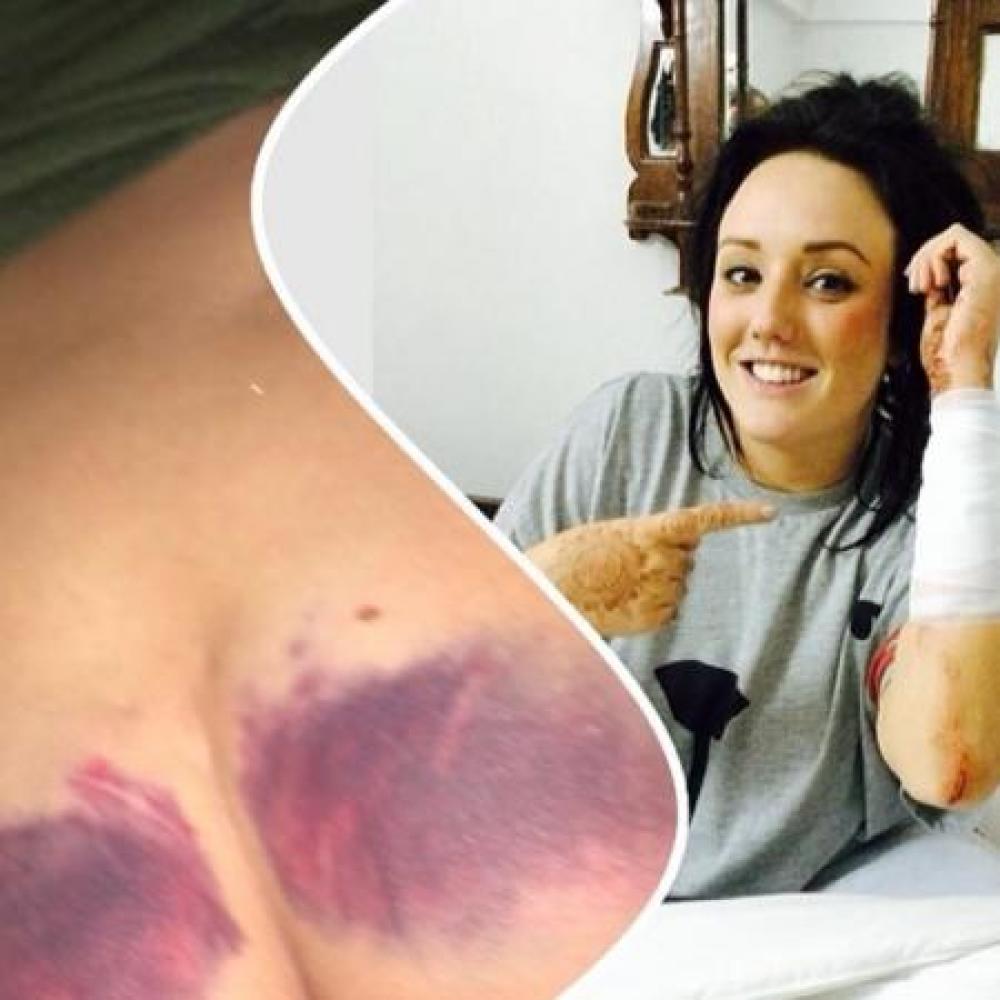 Charlotte Crosby shows off her injuries (c) Instagram