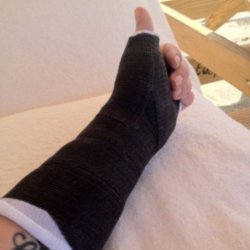 Kelly Osbourne's arm in plaster