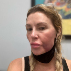 Brandi Glanville's swollen face (c) X