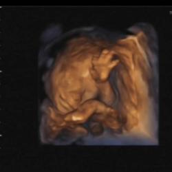 JJ Hamblett's baby ultrasound