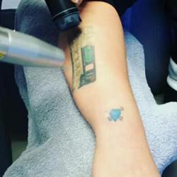 Kelly Osbourne getting her tattoo removed