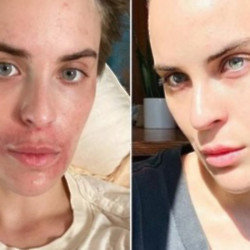 Tallulah Willis has shown off the dramatic “healing” she has experienced from her skin picking disorder