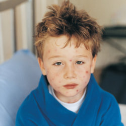 Ensure you protect your child's health and know the signs of chickenpox